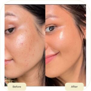 chemical peel treatment in islamabad before after
