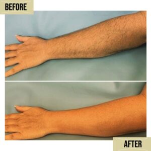 laser hair removal bafore after