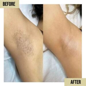 laser hair removal islamabad