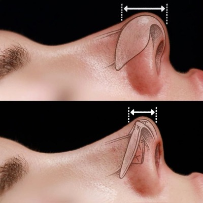 Complete Guide to Nose Tip Plasty & Rhinoplasty